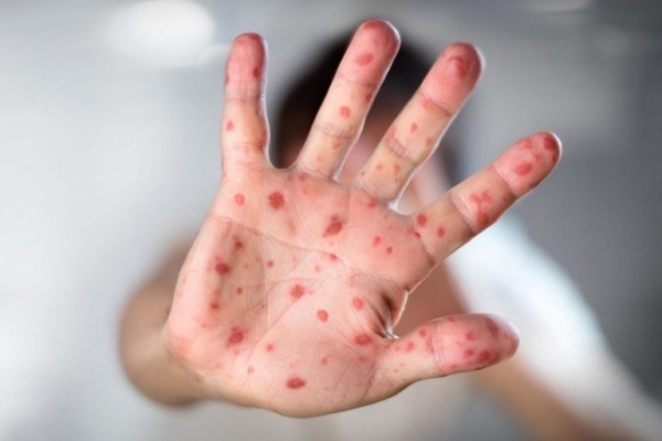 Небезпечний вірус: за два тижні на Прикарпатті зареєстровано понад 200 зверненнь з підозрою на кір