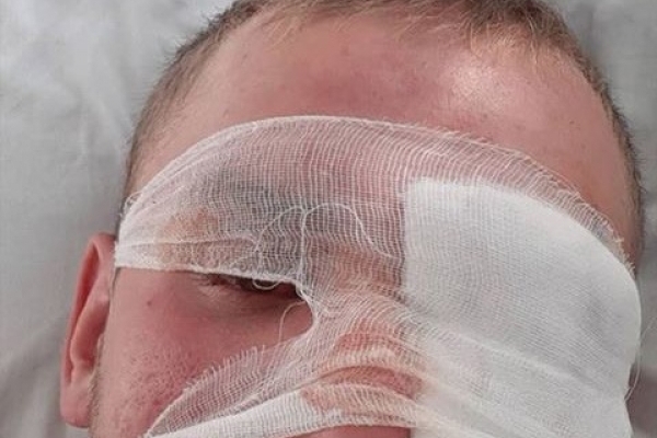 20-річний калушанин, в якого вистрелили з травмата, втратив око